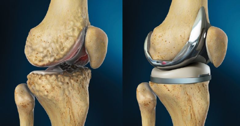Knee and hip surgeries in kenya