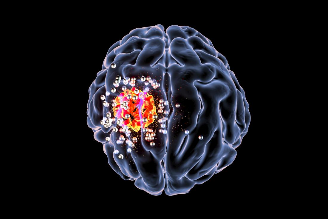 4-successful-ways-to-treat-brain-tumors