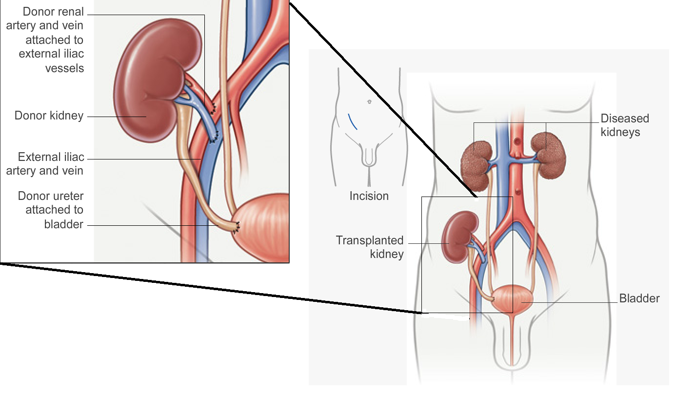 How Long Recovery From Kidney Transplant