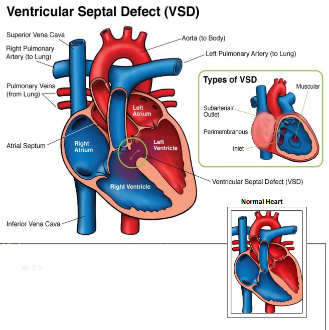 Ventricular Septal Defect (VSD) 5 Lesser Known Facts