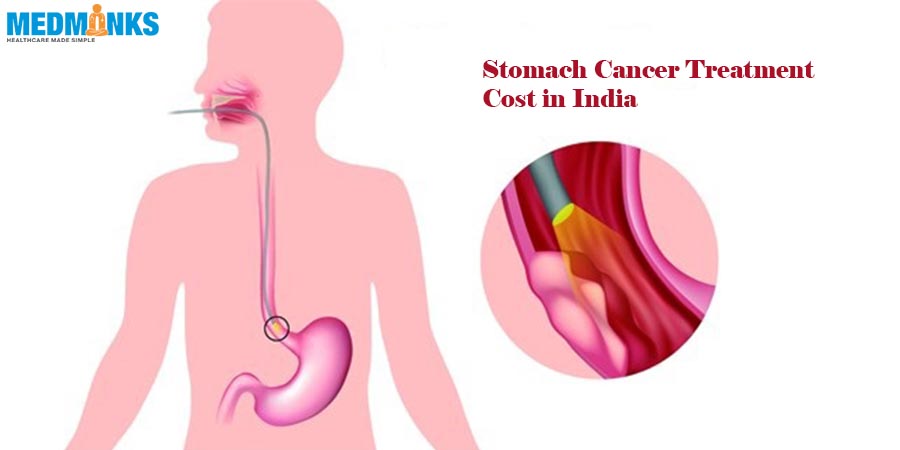تكلفة علاج سرطان المعدة في الهند Medmonks